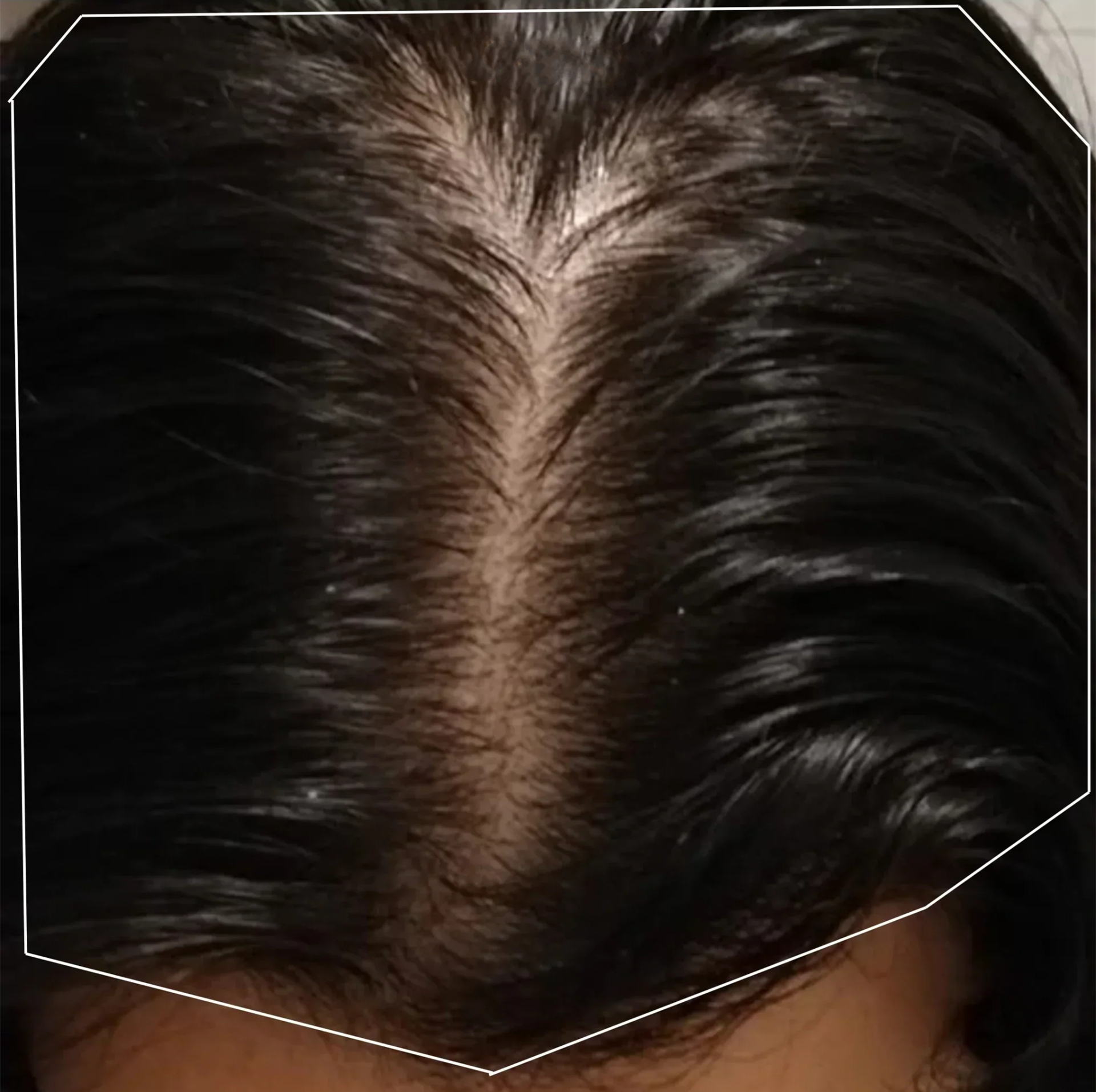 Fatima before using MINOXI