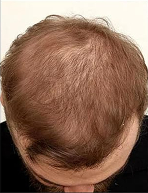 Ahmed before using MINOXI