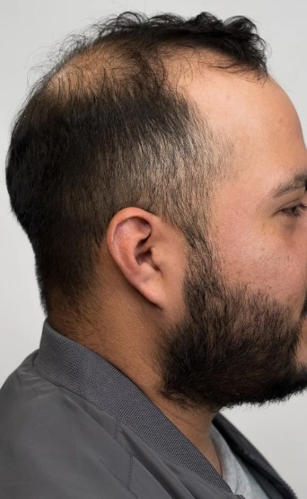 Mohamed before using MINOXI